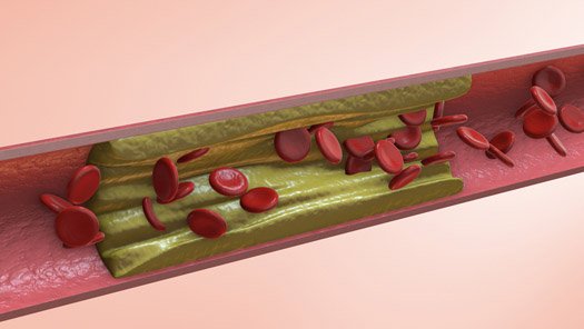 Illustration of Severe Aortic Stenosis (AS)